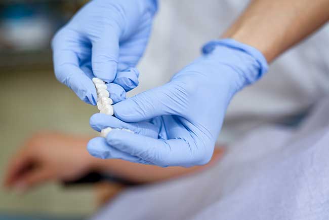 Dental Bridges