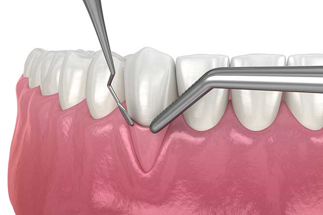 Soft Tissue Graft 3D 2